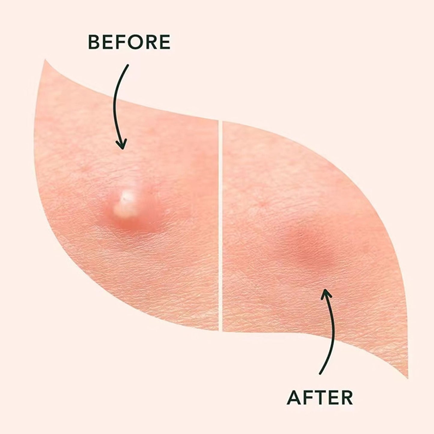 🔥🤩🔥Cute star-shaped acne patches, safe ingredients, 🥳popular among the public🥰