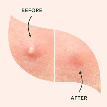 🔥🤩🔥Cute star-shaped acne patches, safe ingredients, 🥳popular among the public🥰